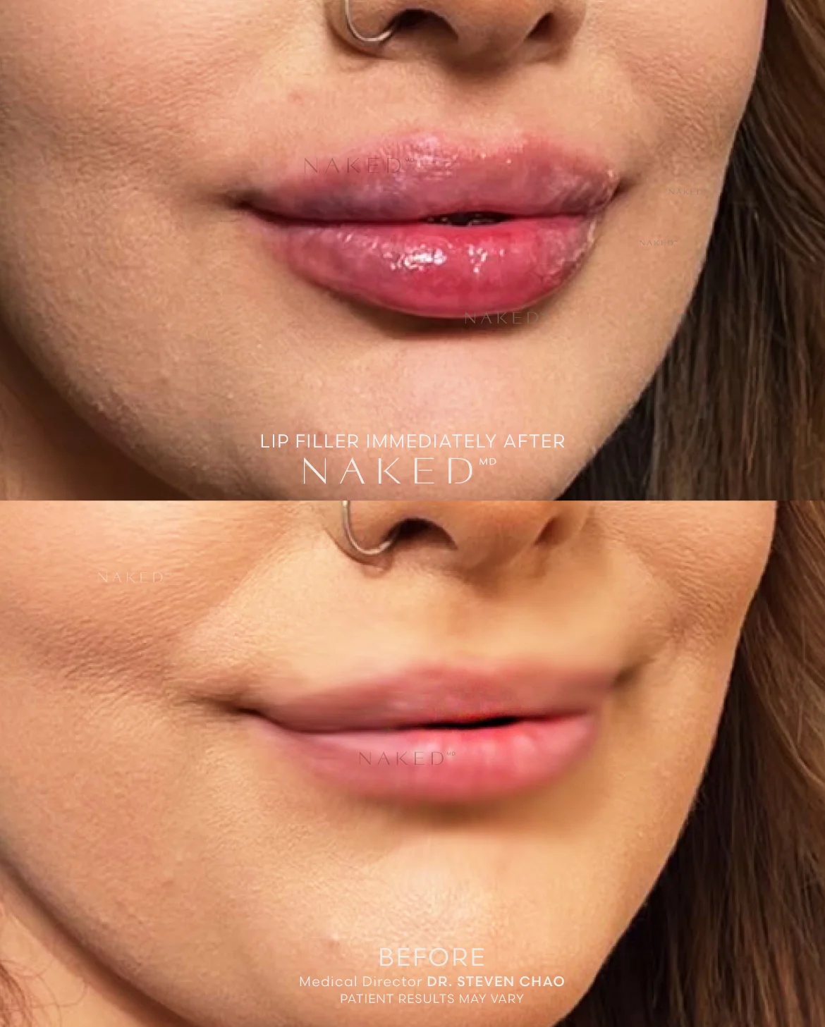 Naked Lips | Lip Filler - Image 55