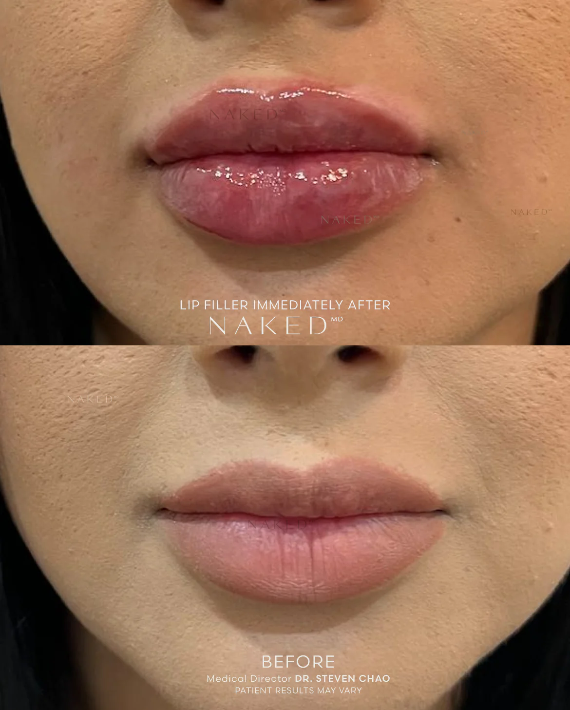 Naked Lips | Lip Filler - Image 56