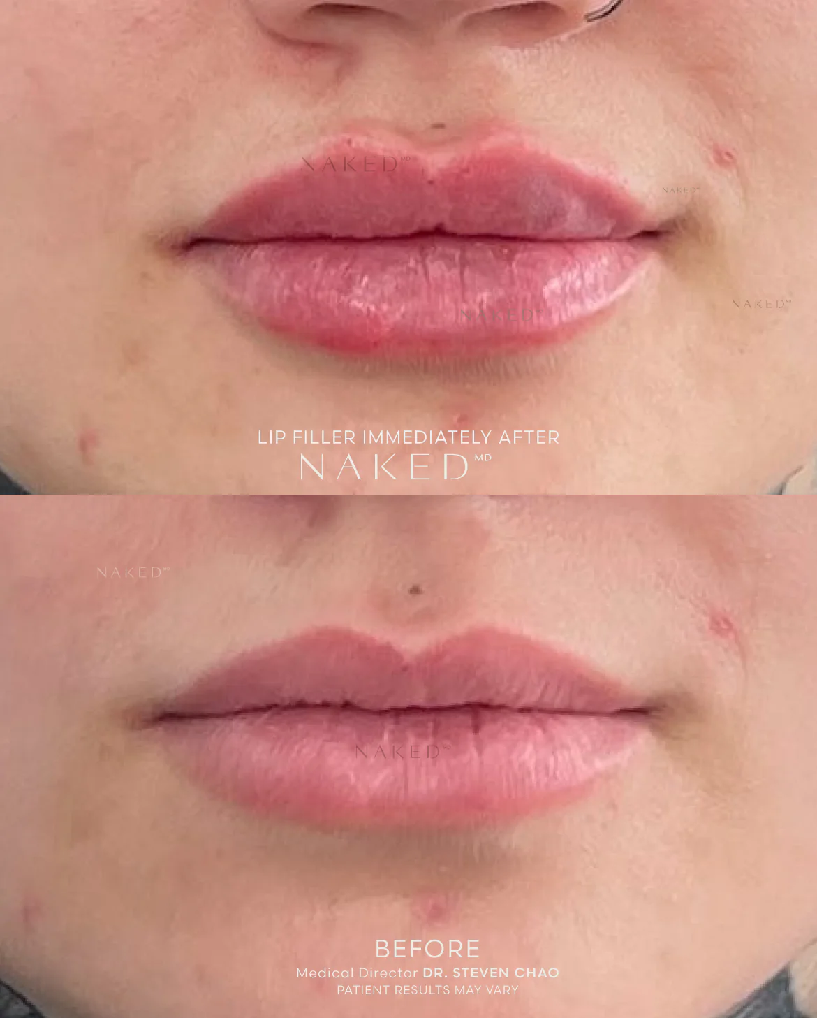 Naked Lips | Lip Filler - Image 57