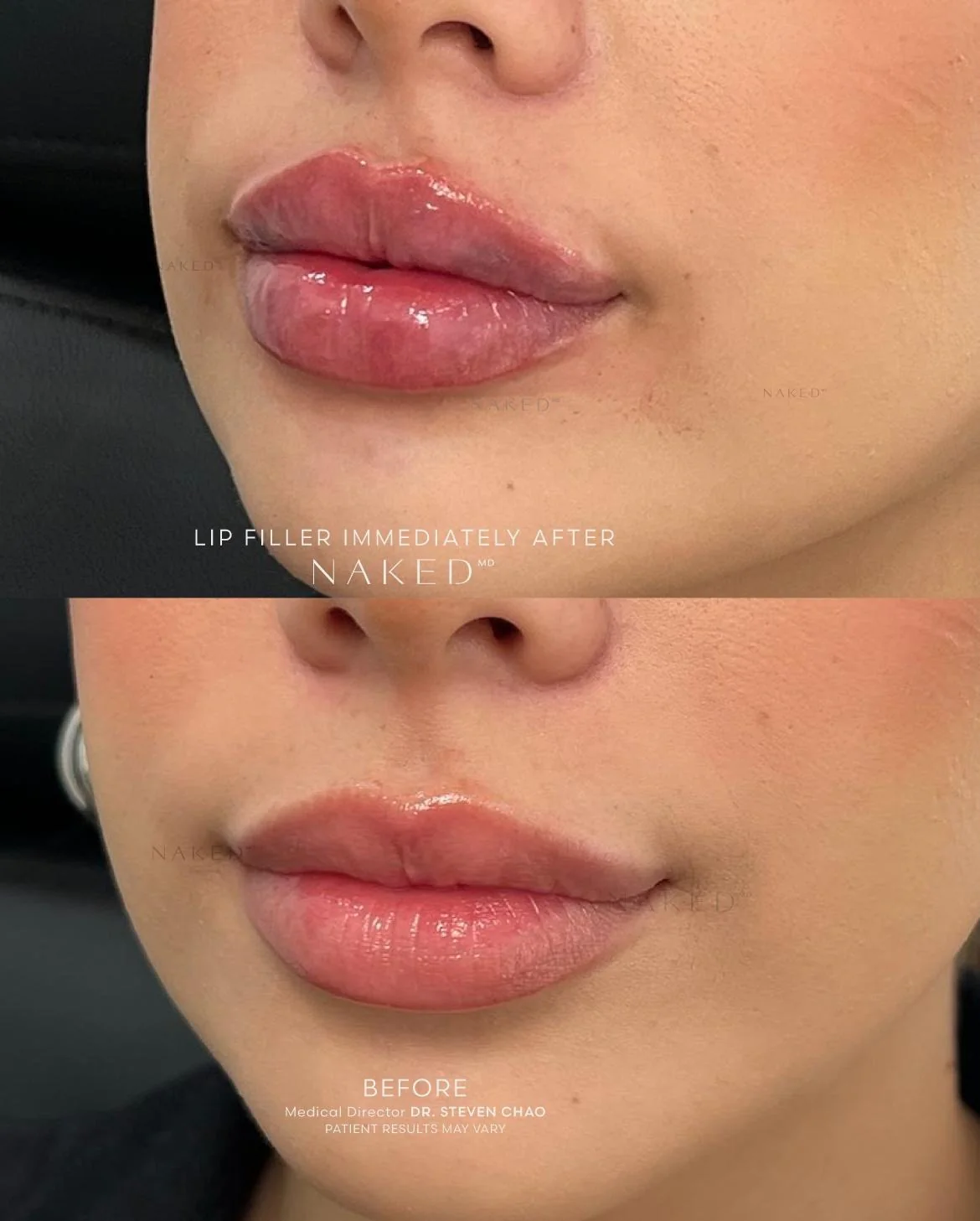 Naked Lips | Lip Filler - Image 58