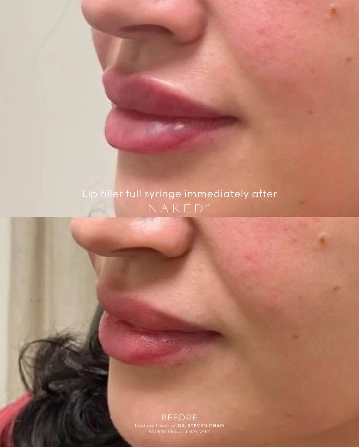Naked Lips | Lip Filler - Image 59