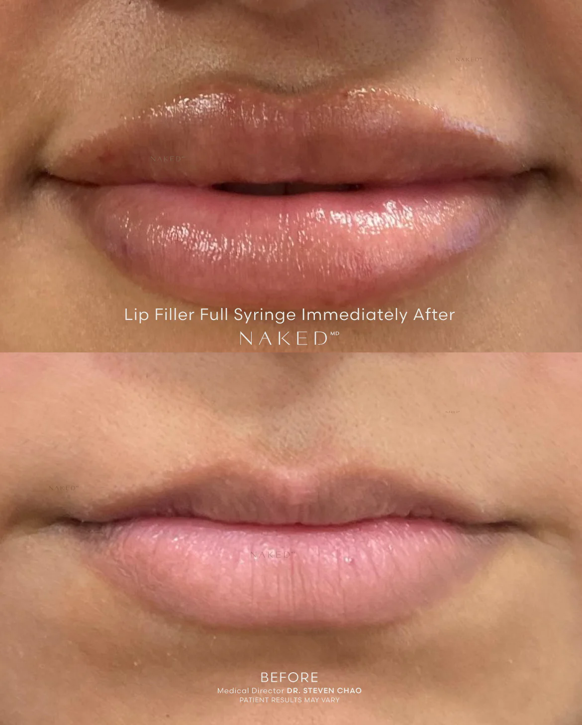Naked Lips | Lip Filler - Image 60