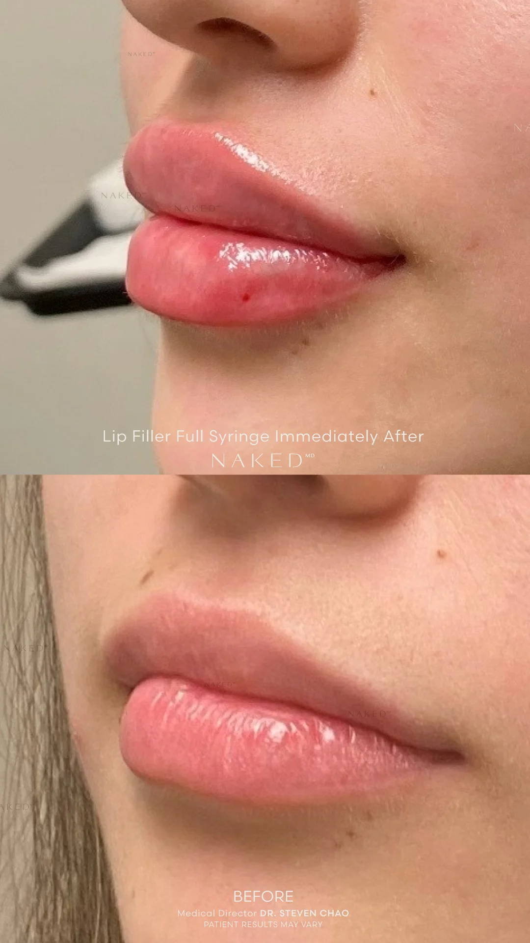 Naked Lips | Lip Filler - Image 61