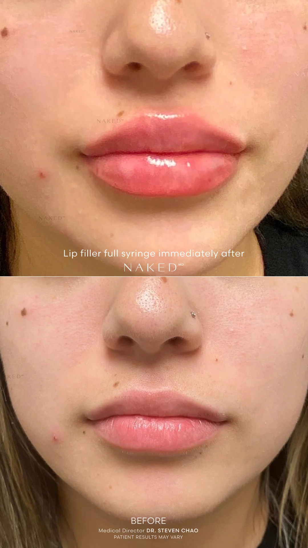 Naked Lips | Lip Filler - Image 62