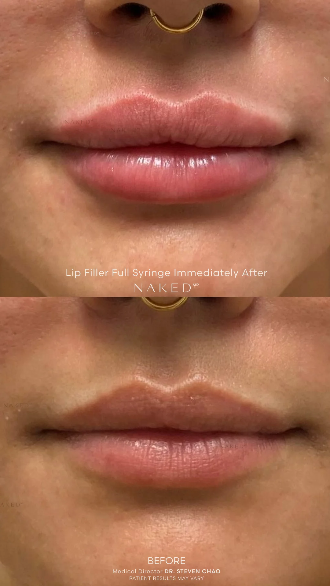 Naked Lips | Lip Filler - Image 63