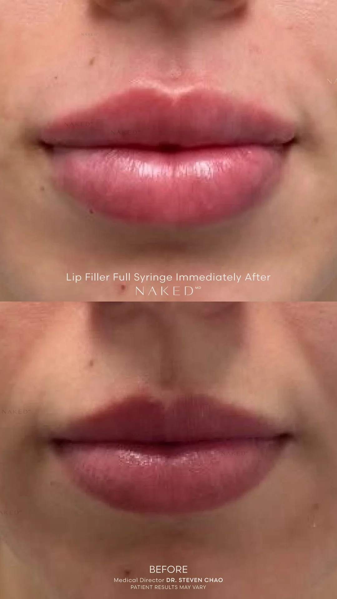 Naked Lips | Lip Filler - Image 64