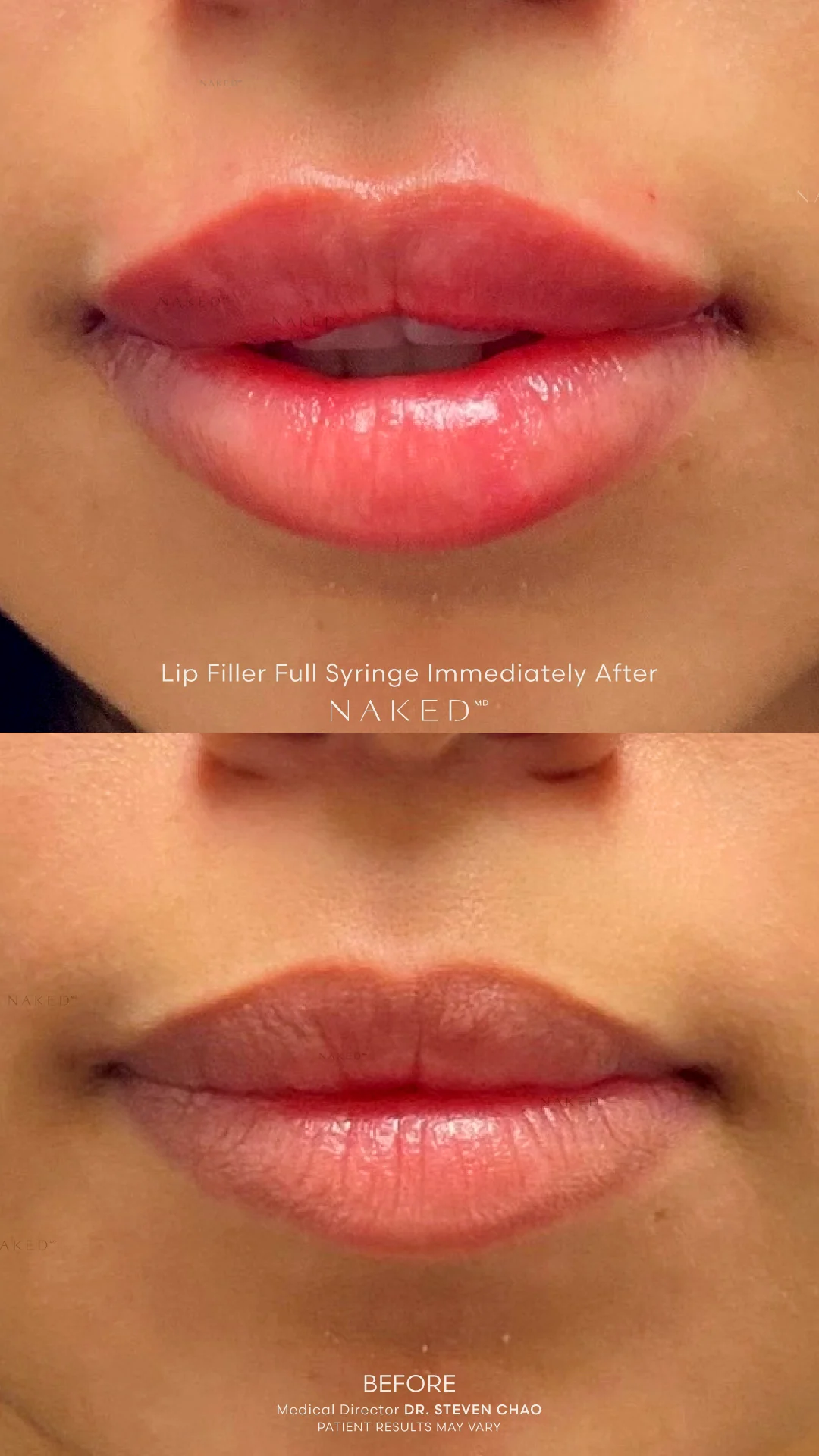Naked Lips | Lip Filler - Image 65