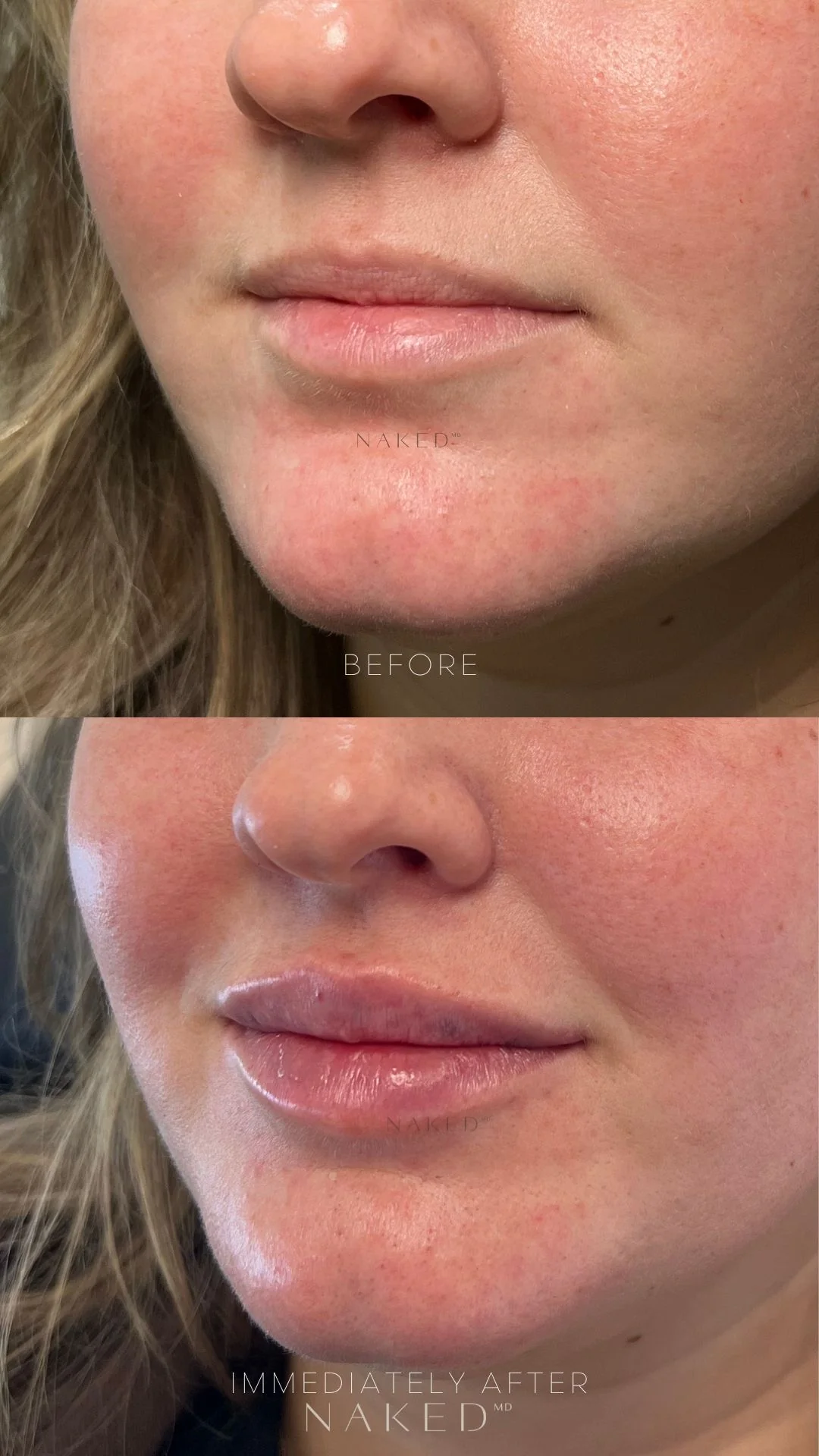 Naked Lips | Lip Filler - Image 69