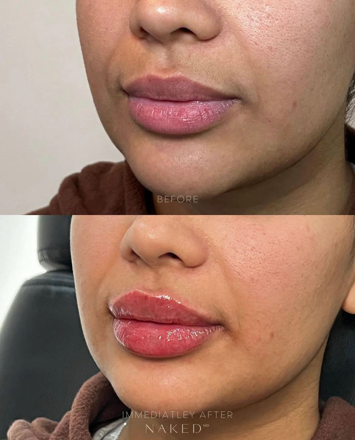 Naked Lips | Lip Filler - Image 70