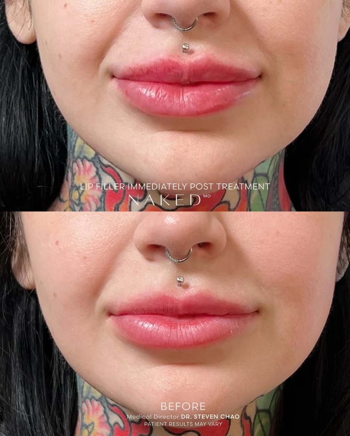 Naked Lips | Lip Filler - Image 71