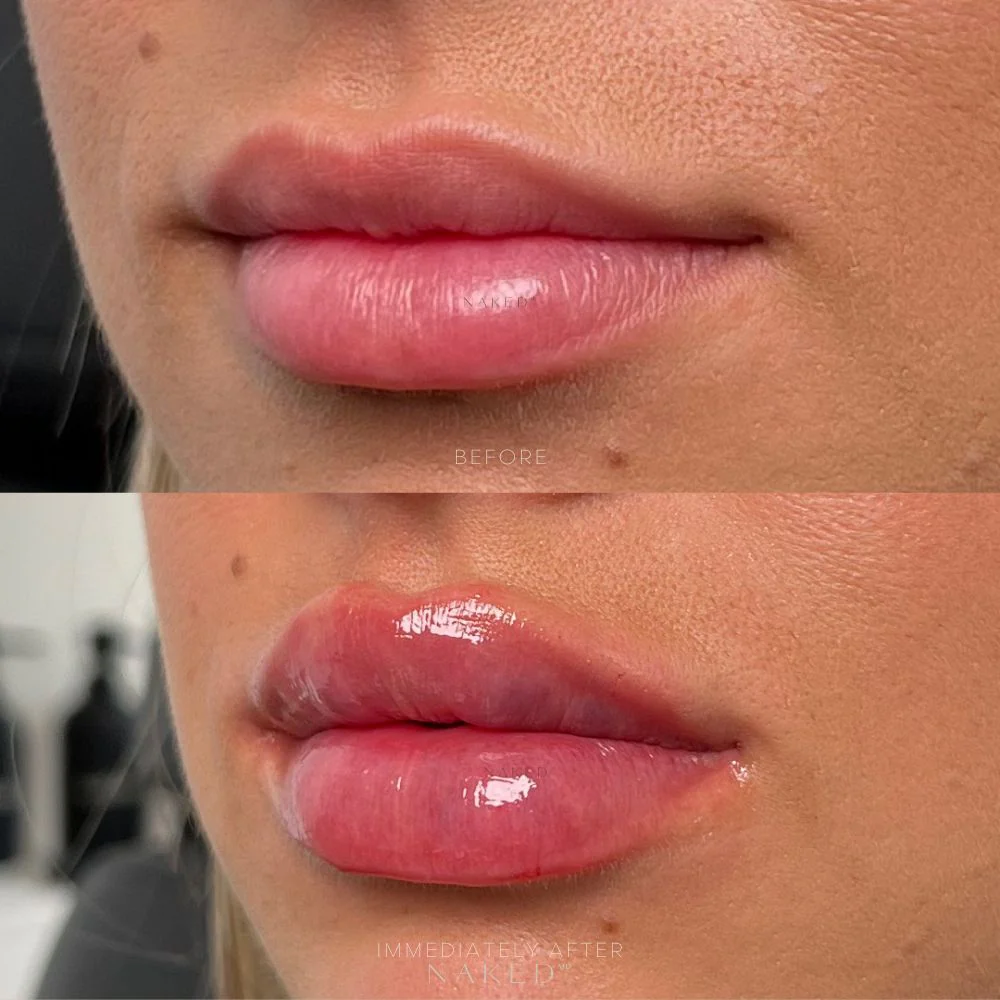 Naked Lips | Lip Filler - Image 8
