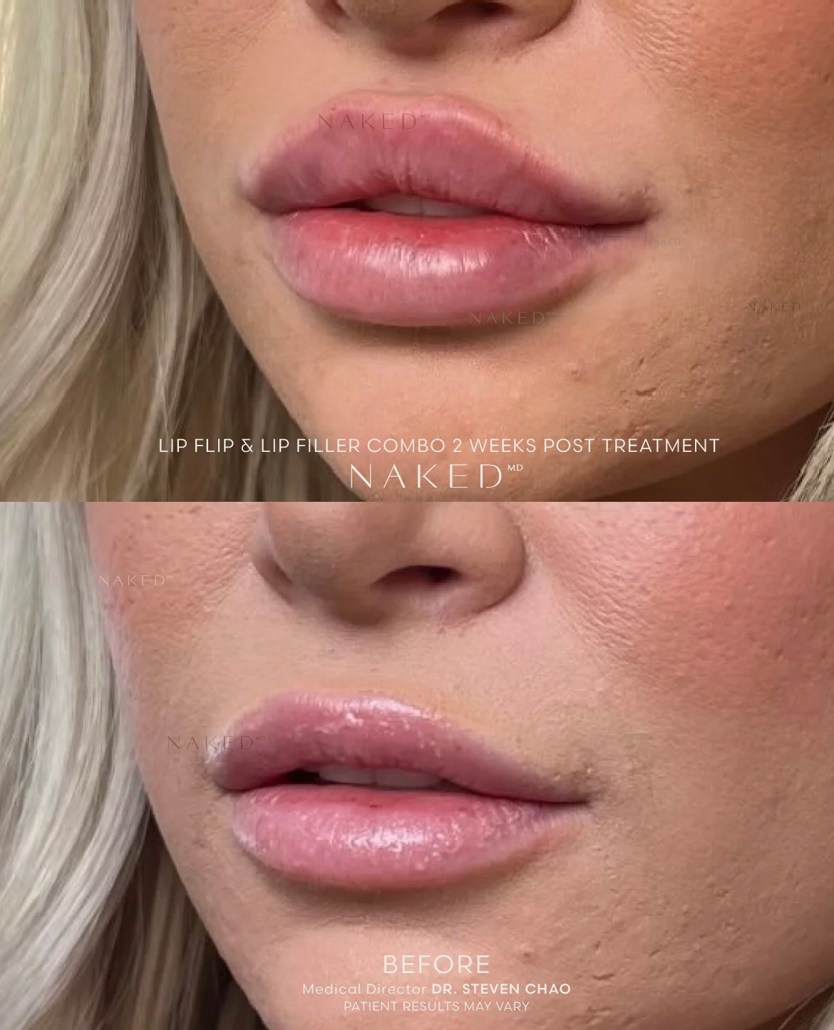 Lip Flip - Image 4