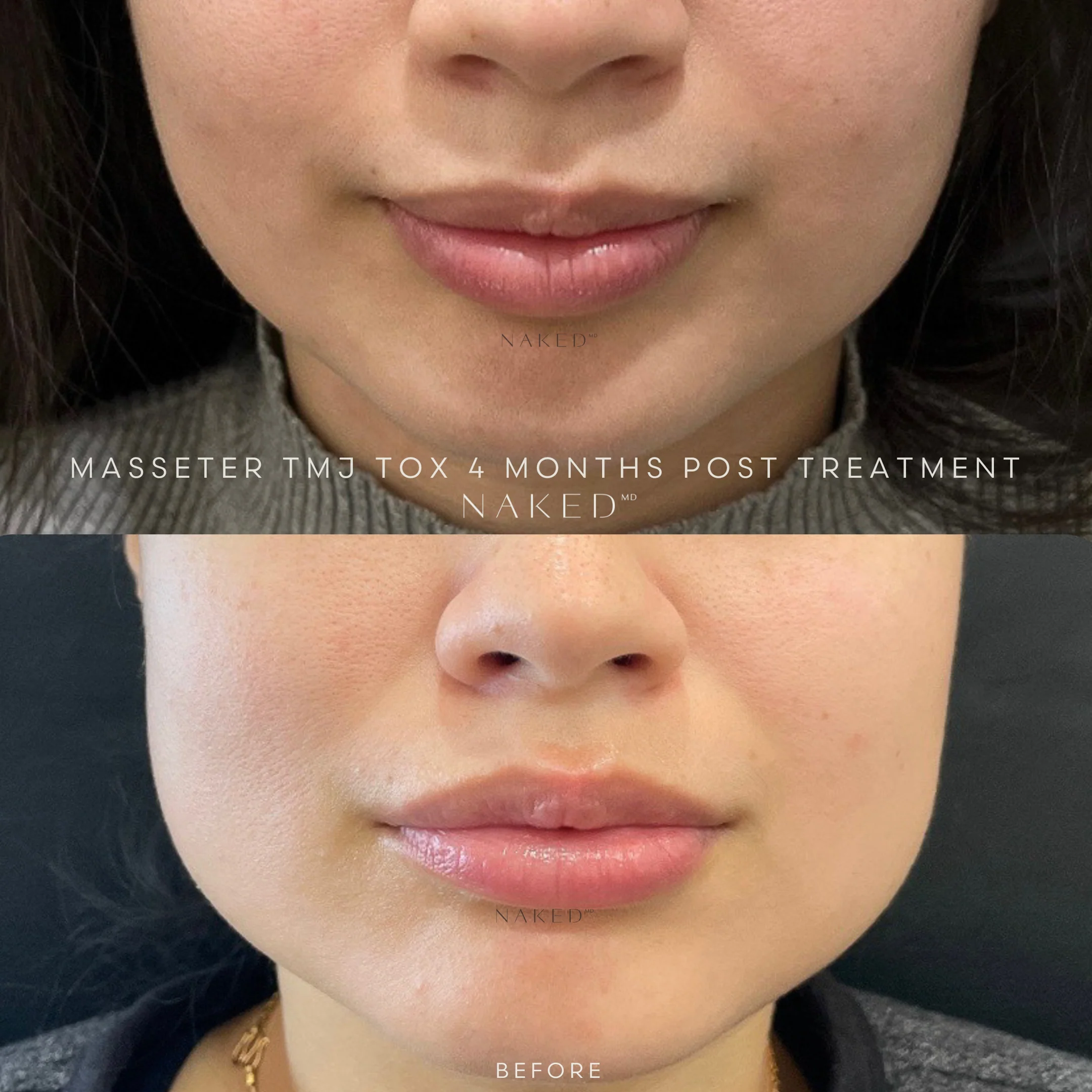 Masseter Reduction | TMJ - Image 5