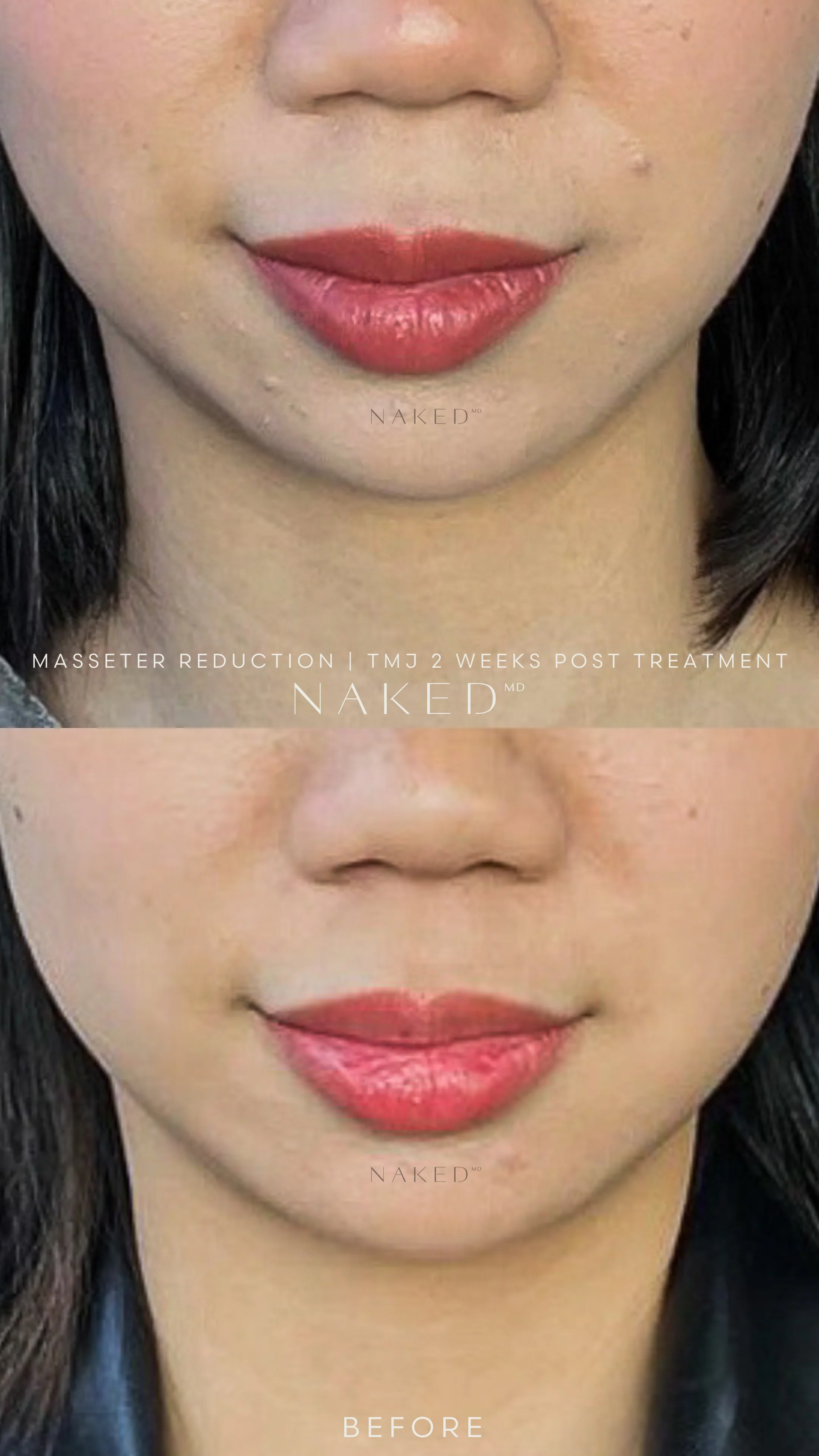 Masseter Reduction | TMJ - Image 6