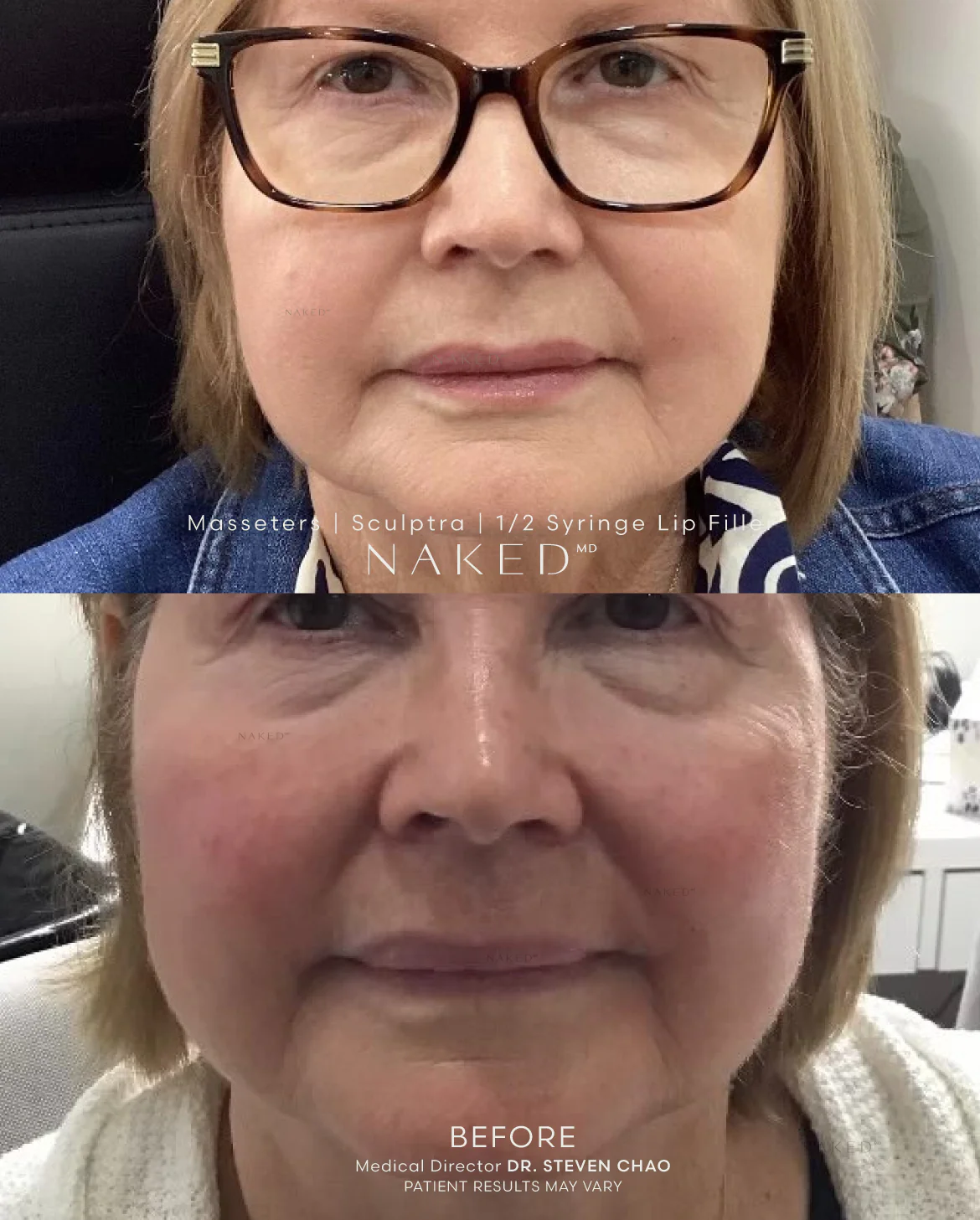 Masseter Reduction | TMJ - Image 7