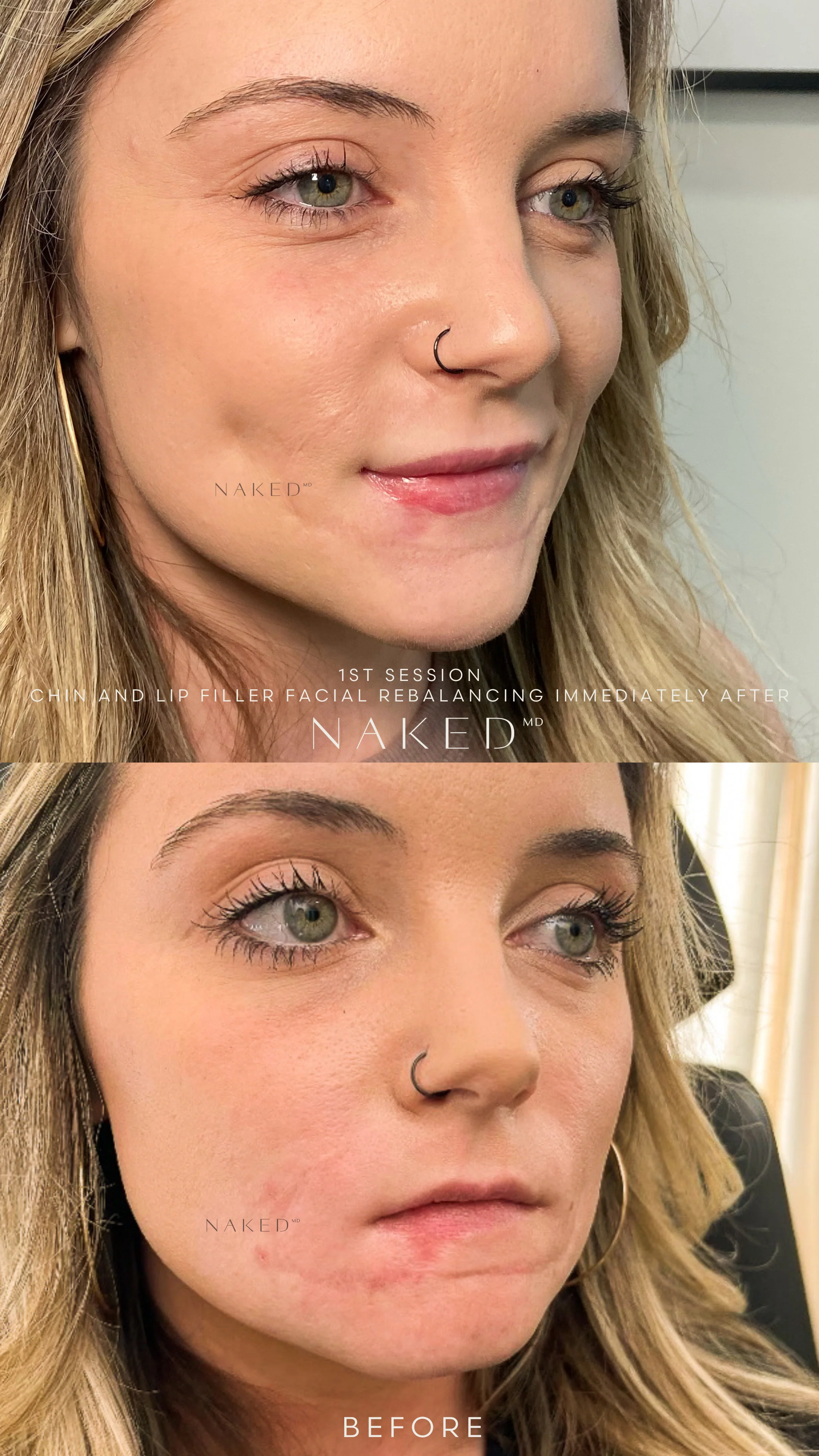 Naked Combo | Lips and Chin - Image 2