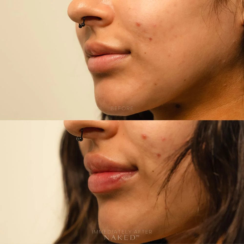 Lip Filler | New Client Offer - Image 10