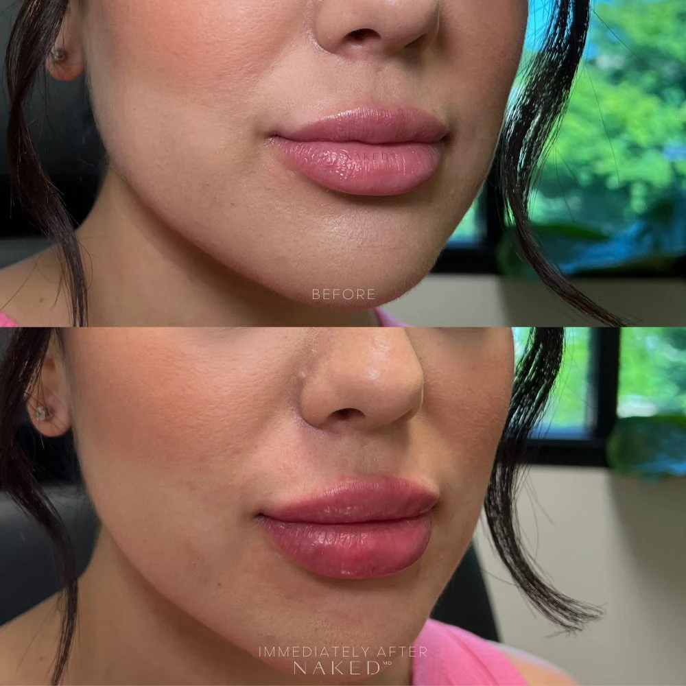 Lip Filler | New Client Offer - Image 11