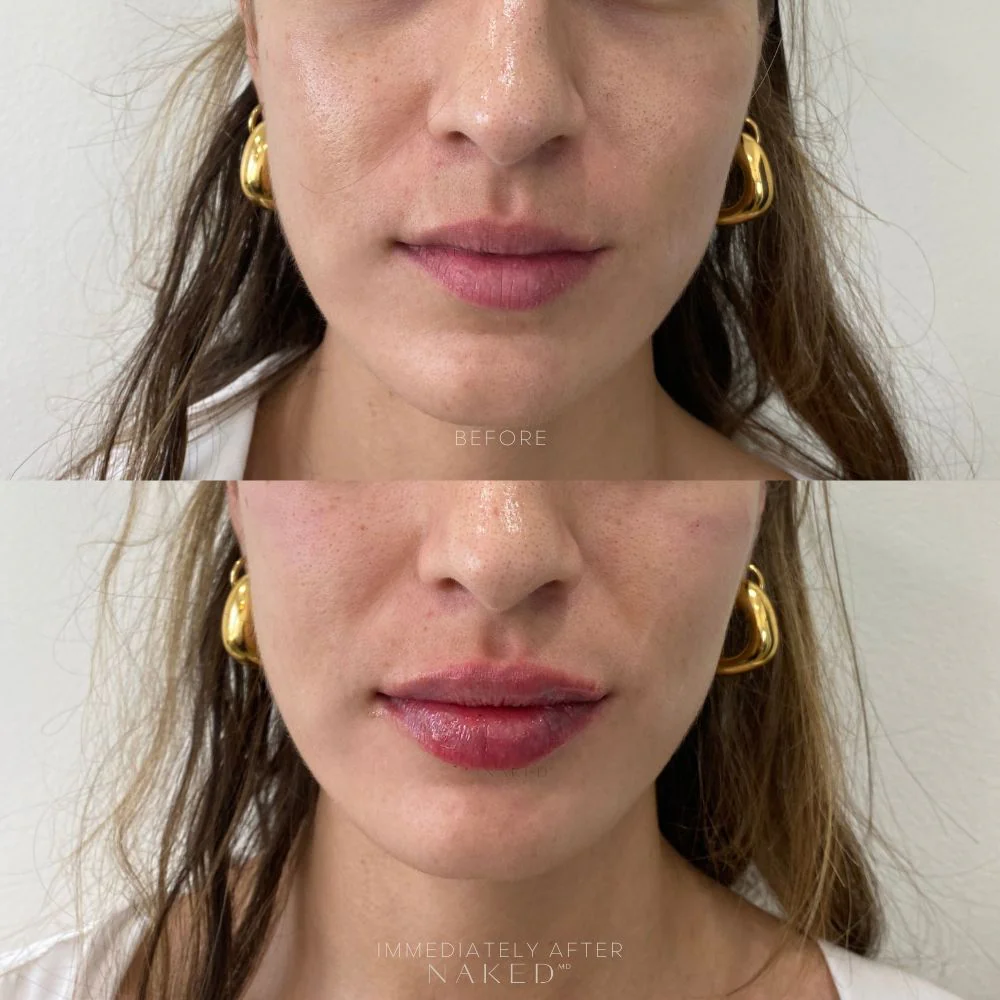 Lip Filler | New Client Offer - Image 12