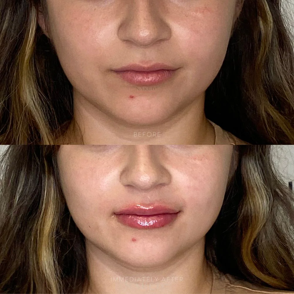Lip Filler | New Client Offer - Image 13
