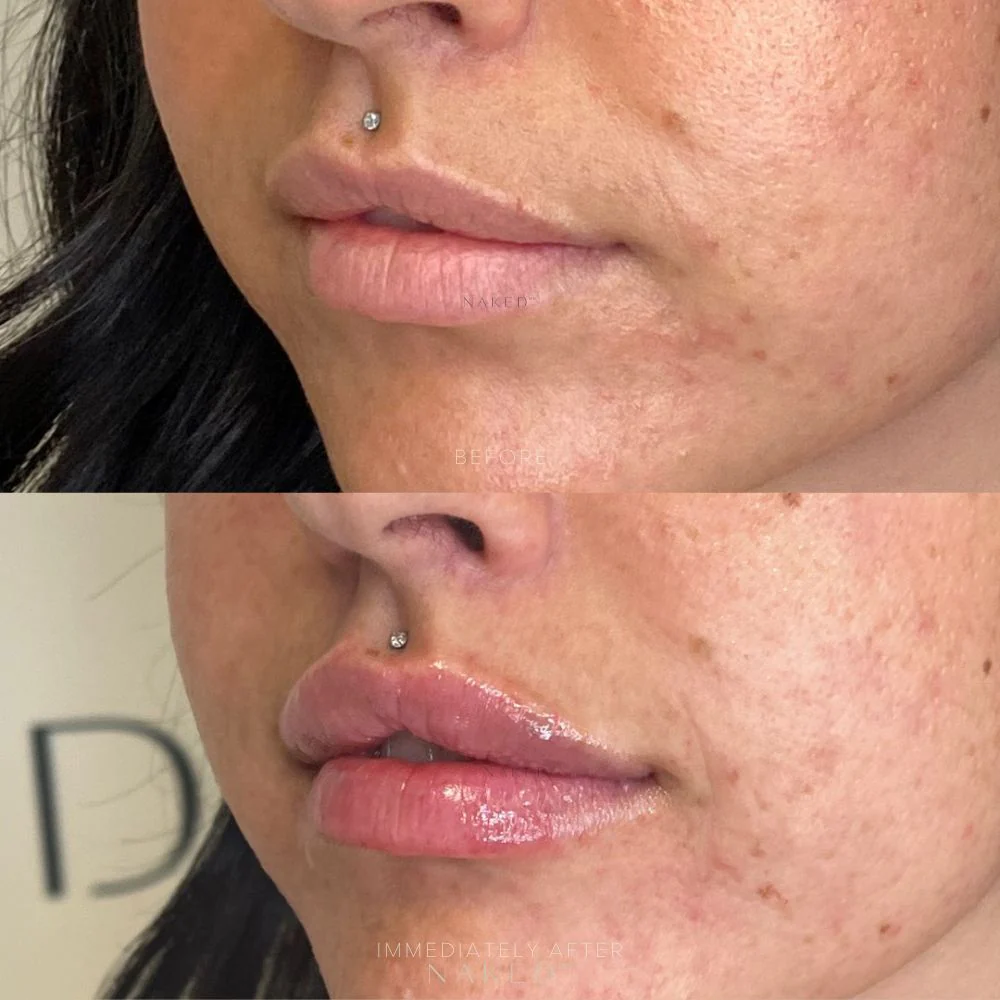 Lip Filler | New Client Offer - Image 15