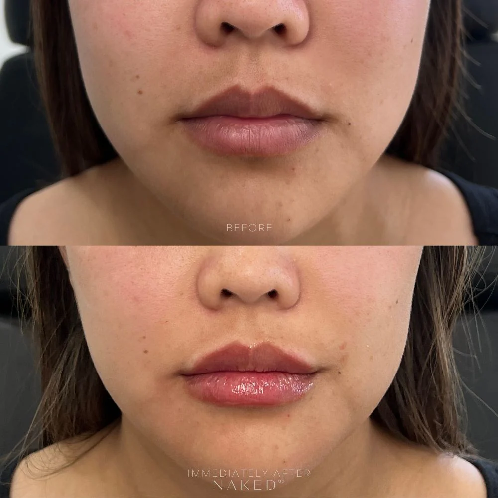 Lip Filler | New Client Offer - Image 16