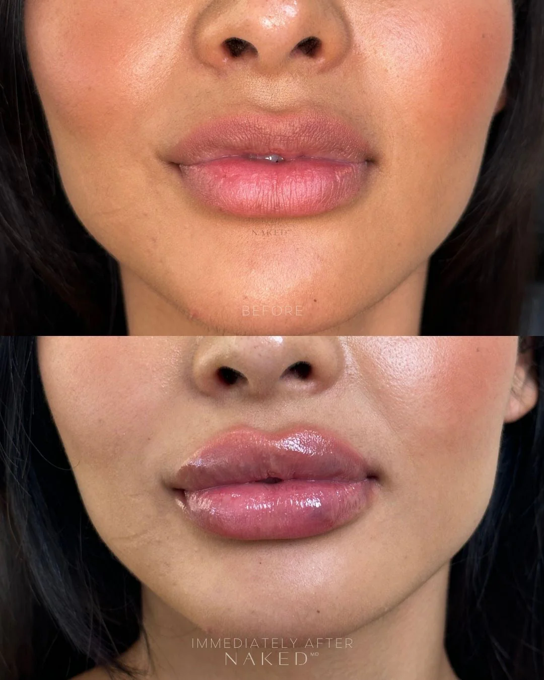 Lip Filler | New Client Offer - Image 18
