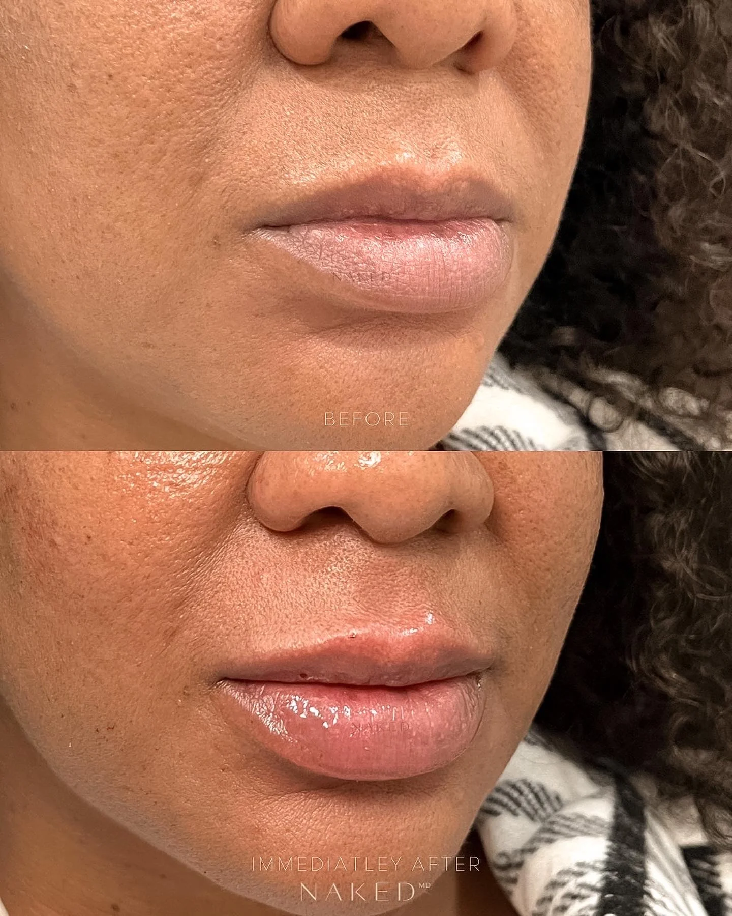 Lip Filler | New Client Offer - Image 19