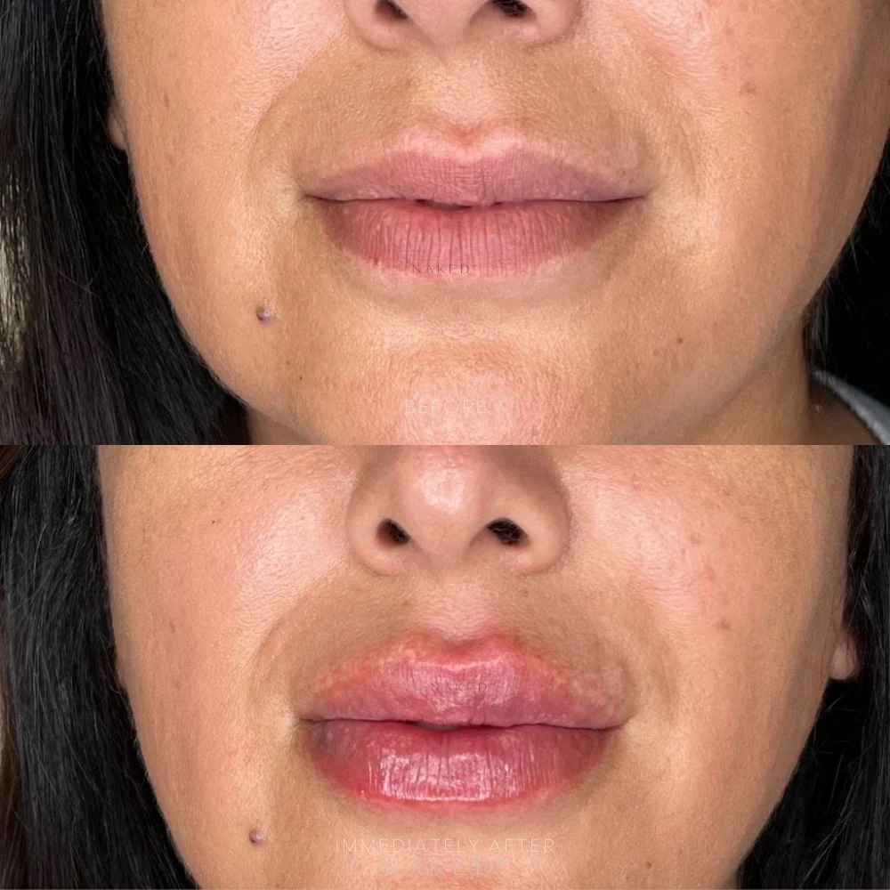 Lip Filler | New Client Offer - Image 23