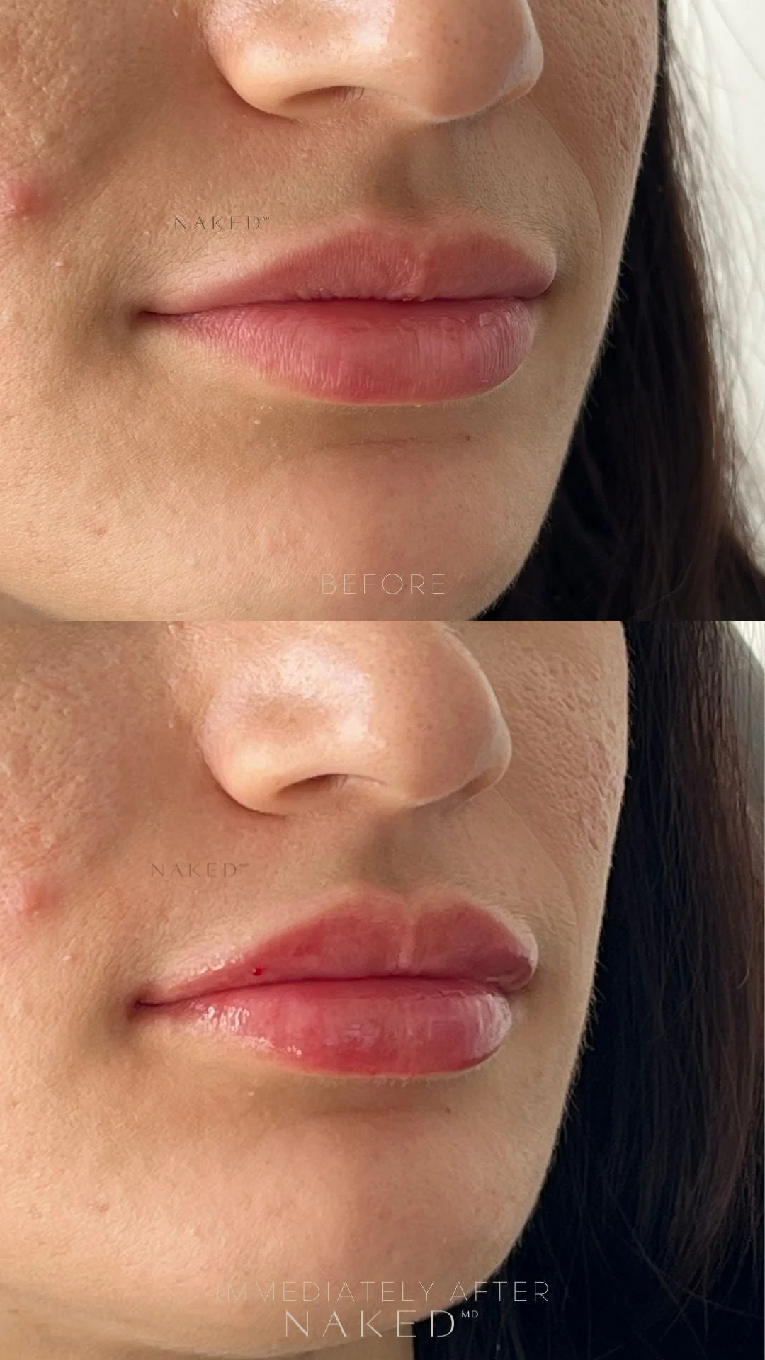 Lip Filler | New Client Offer - Image 26