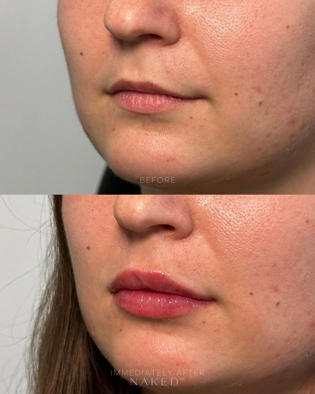 Lip Filler | New Client Offer - Image 27