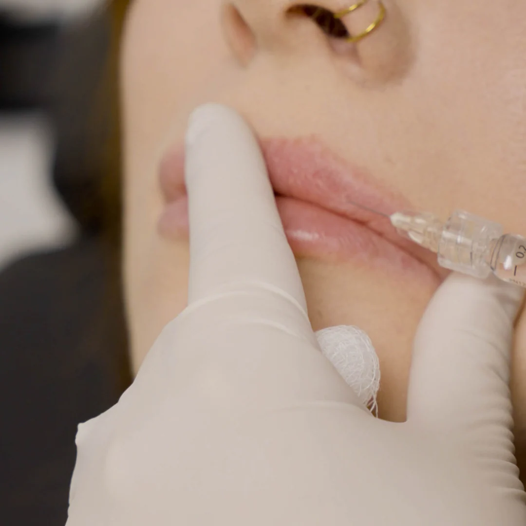 Lip Filler | New Client Offer - Image 28