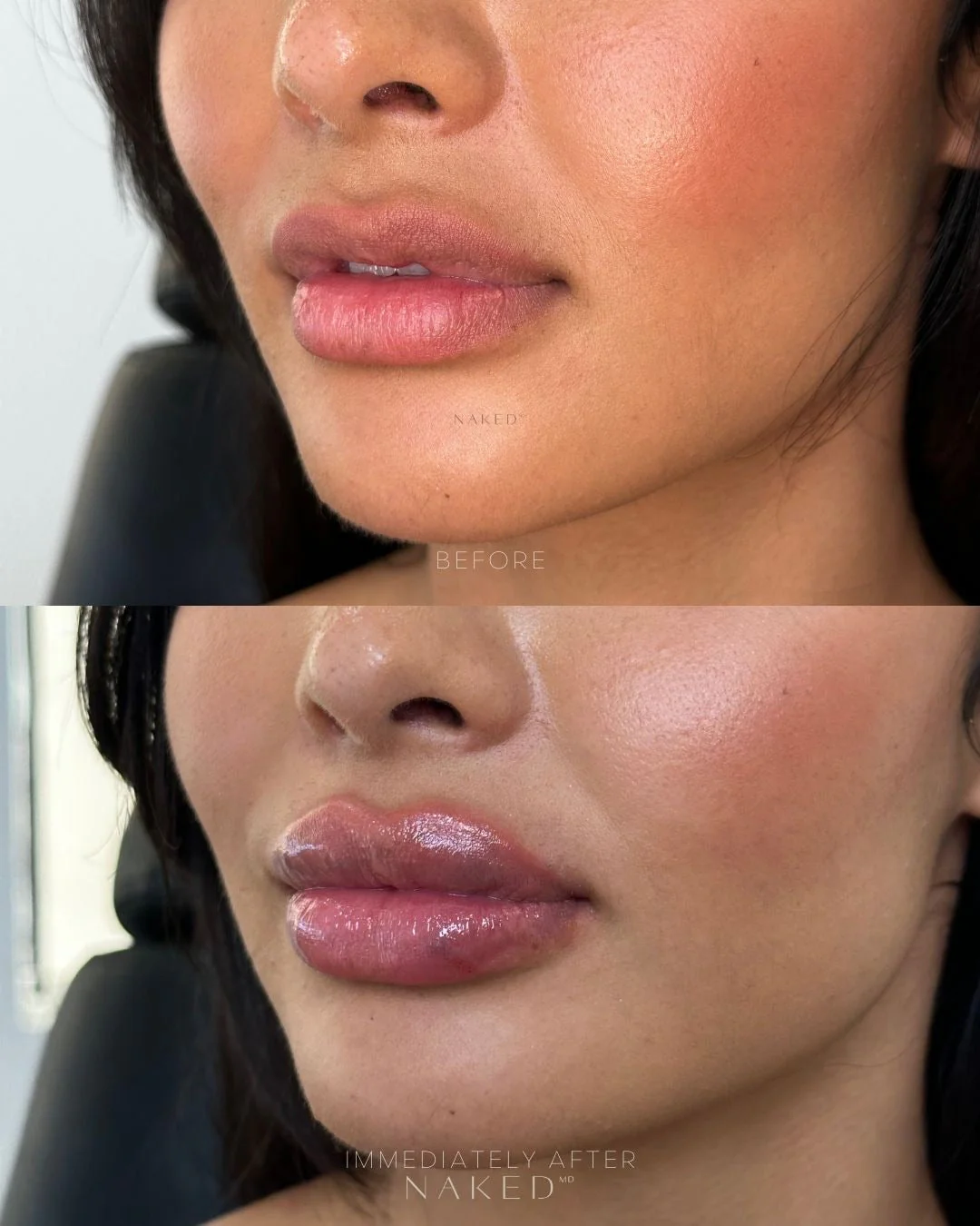 Lip Filler | New Client Offer - Image 29