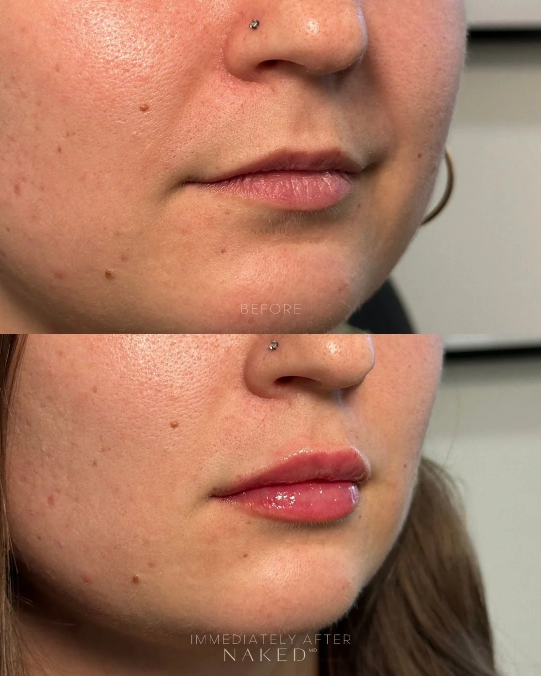 Lip Filler | New Client Offer - Image 30