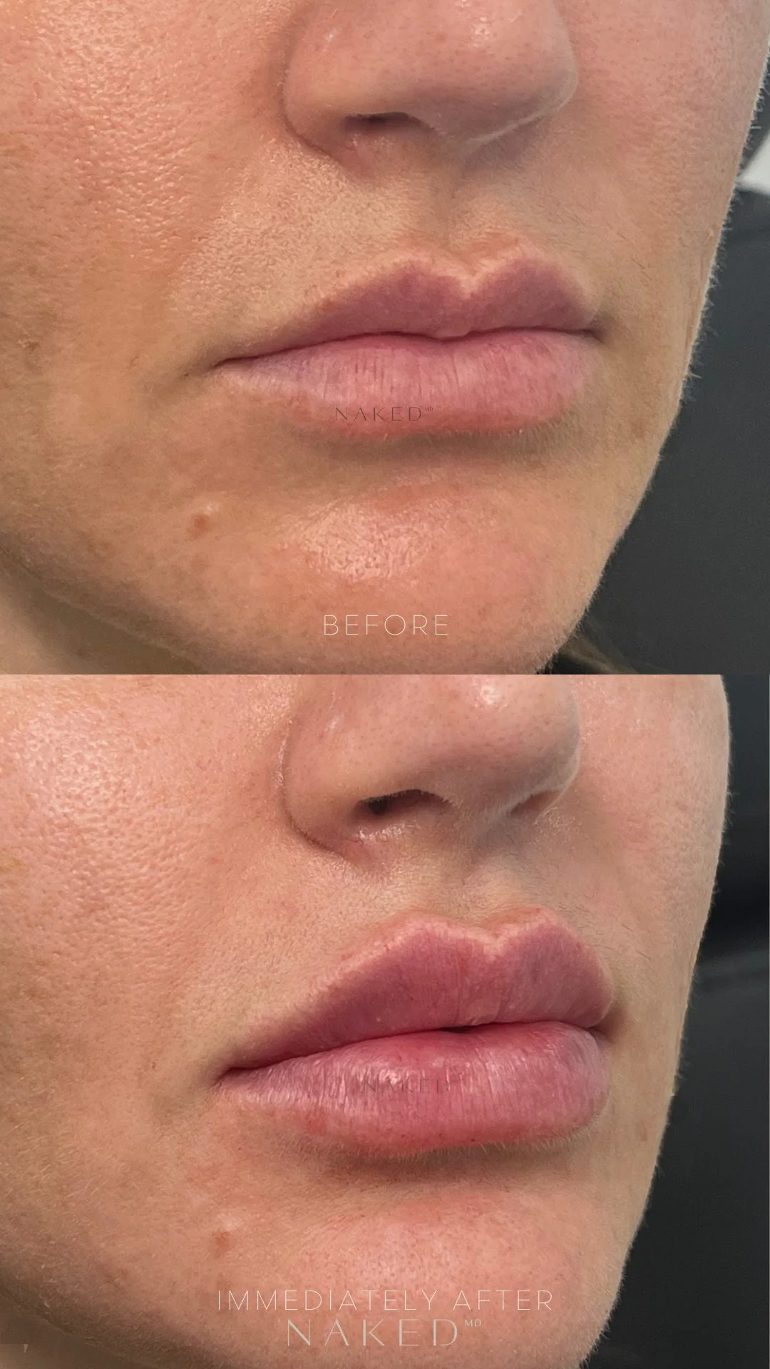 Lip Filler | New Client Offer - Image 31