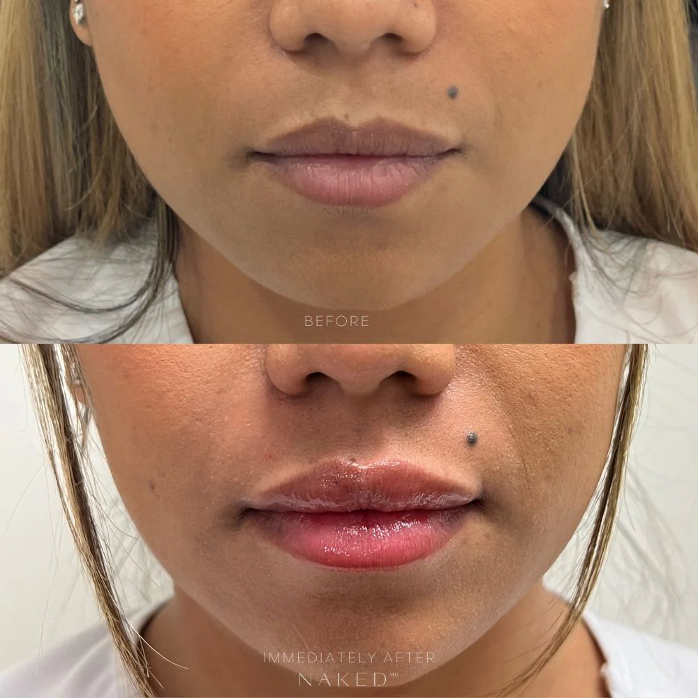 Lip Filler | New Client Offer - Image 35
