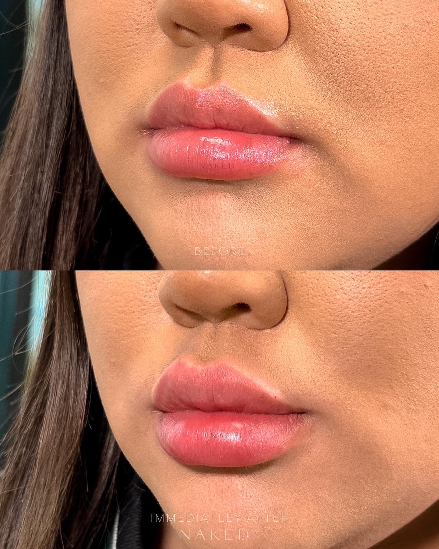 Lip Filler | New Client Offer - Image 38
