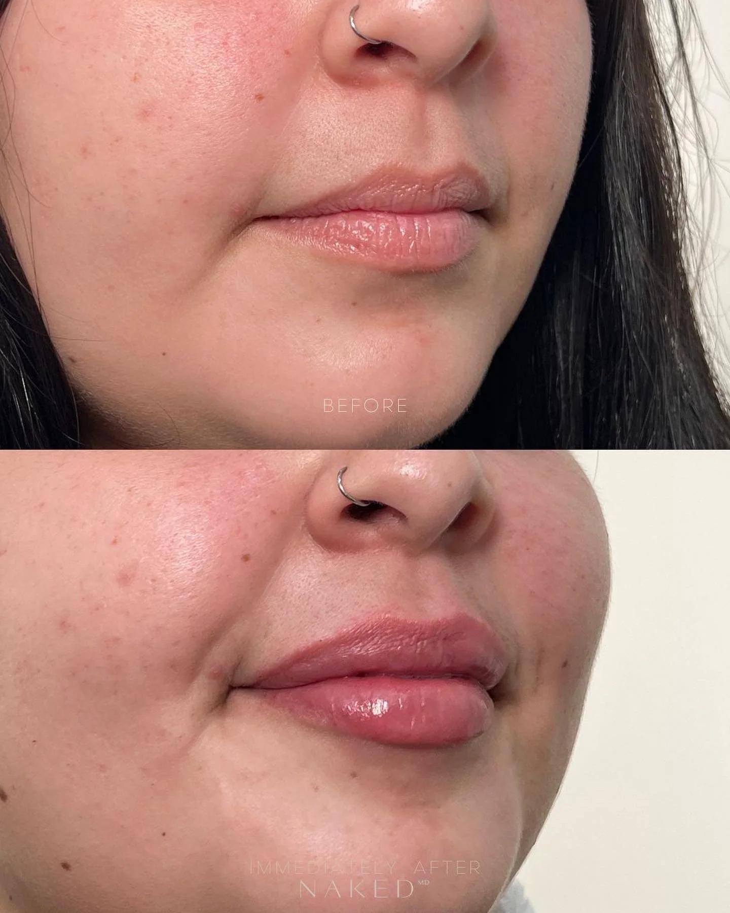 Lip Filler | New Client Offer - Image 39