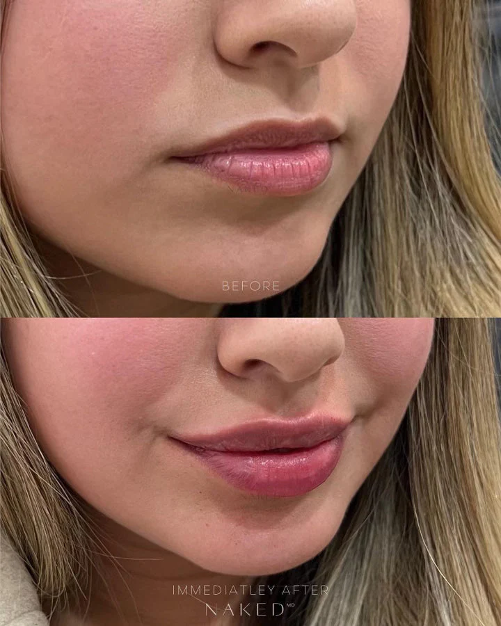 Lip Filler | New Client Offer - Image 4