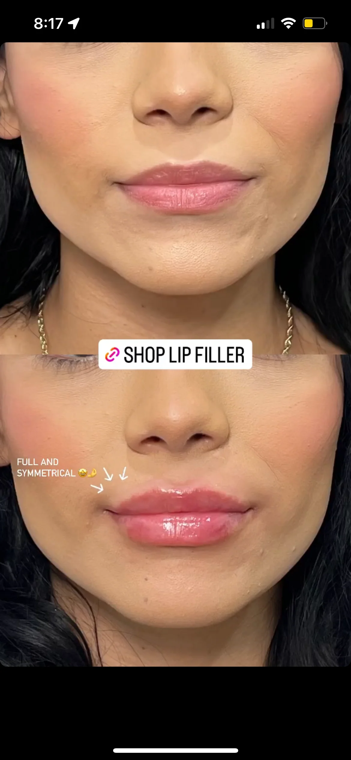 Lip Filler | New Client Offer - Image 48