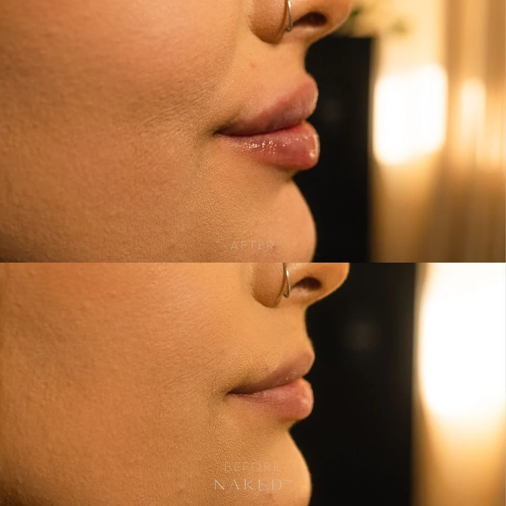 Lip Filler | New Client Offer - Image 5