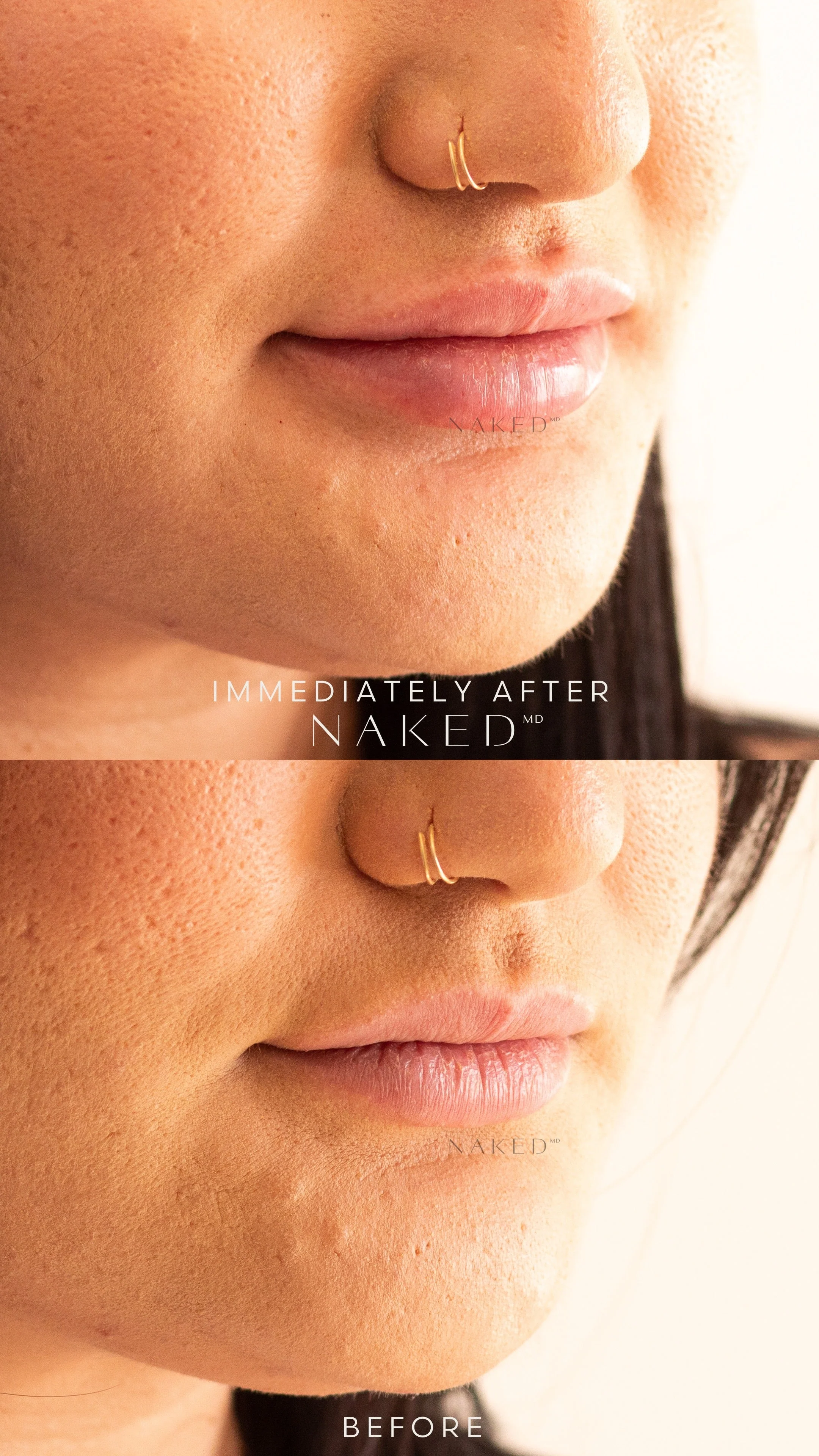 Lip Filler | New Client Offer - Image 53