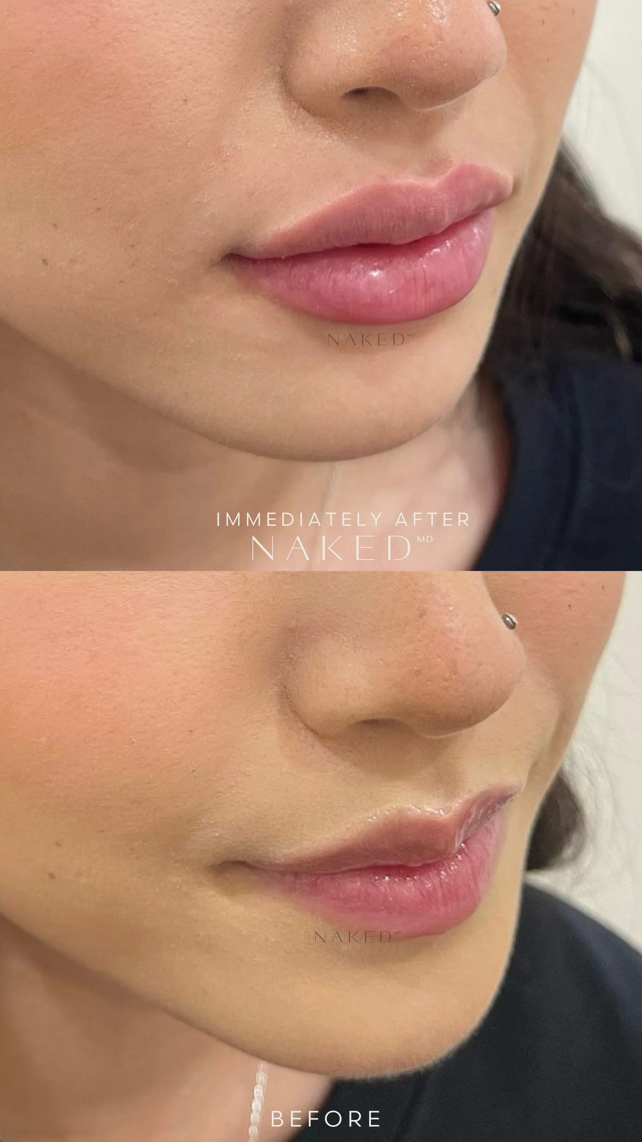 Lip Filler | New Client Offer - Image 54