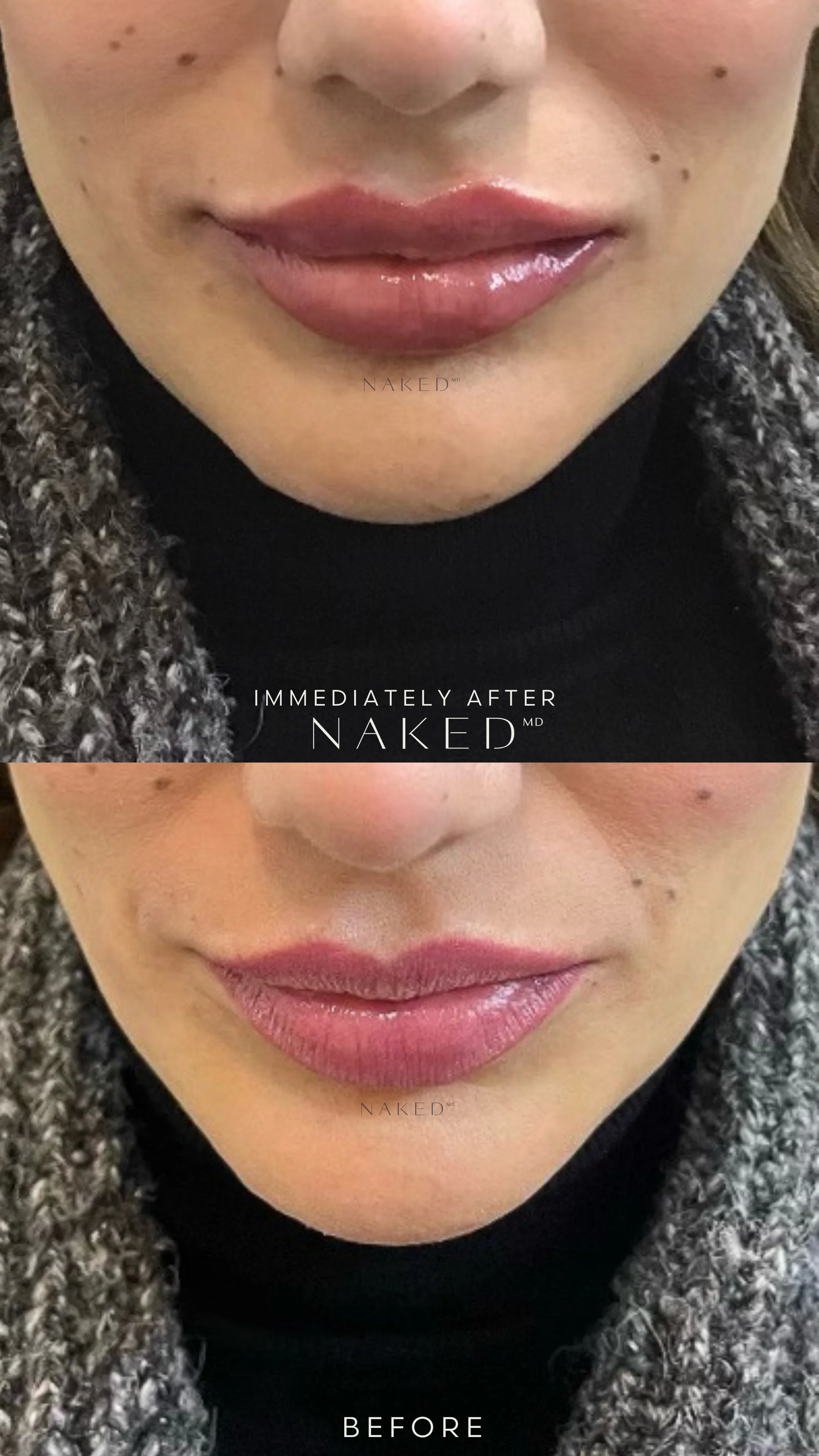 Lip Filler | New Client Offer - Image 55