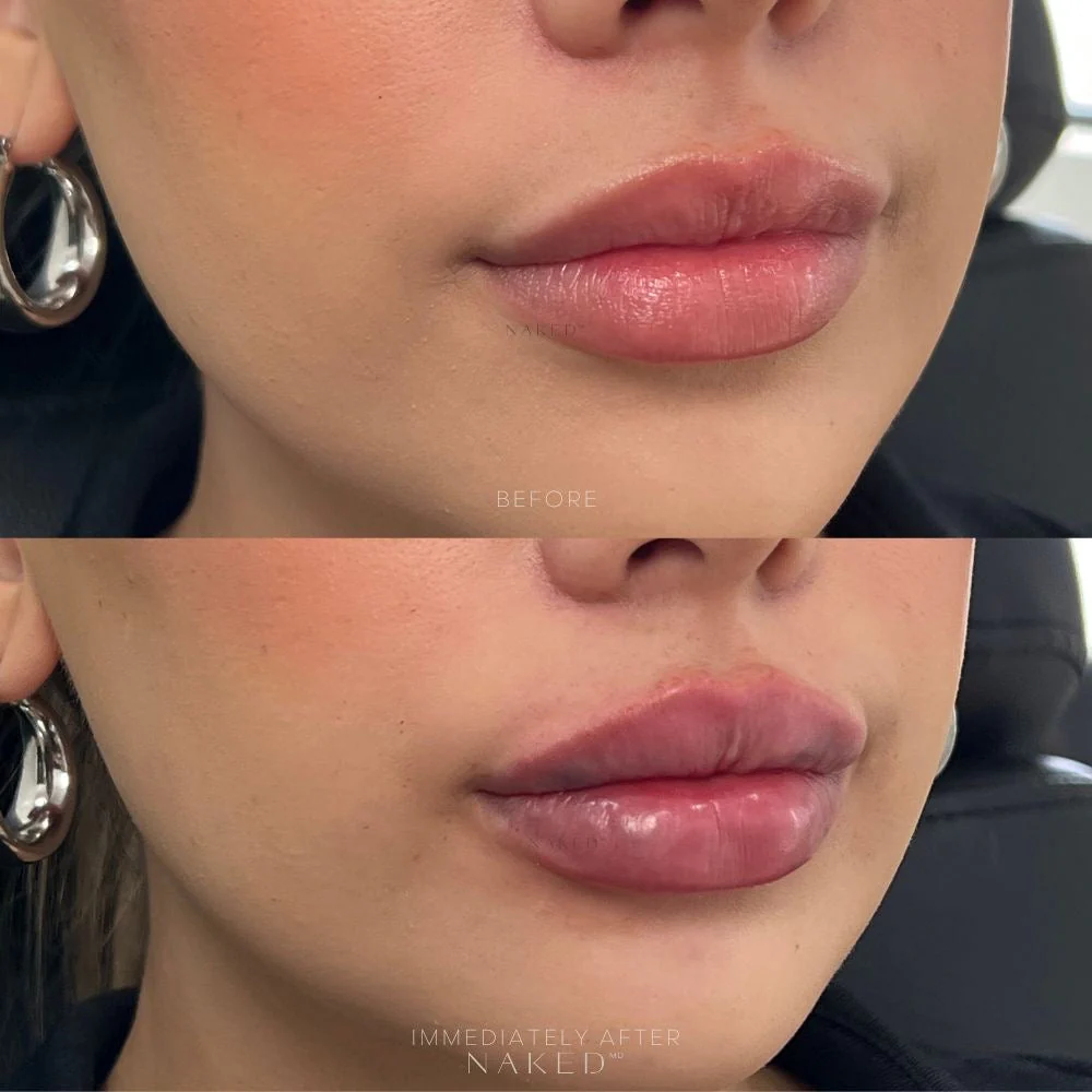 Lip Filler | New Client Offer - Image 56