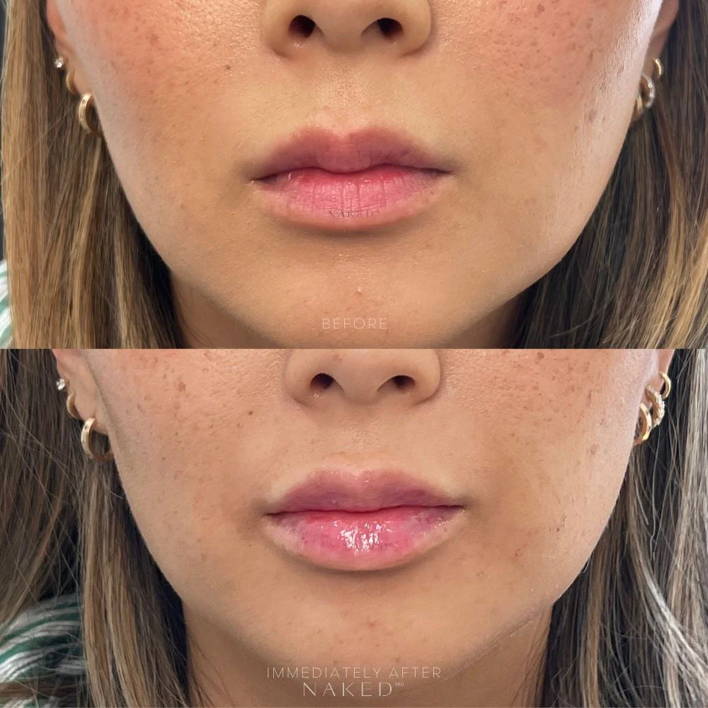 Lip Filler | New Client Offer - Image 57