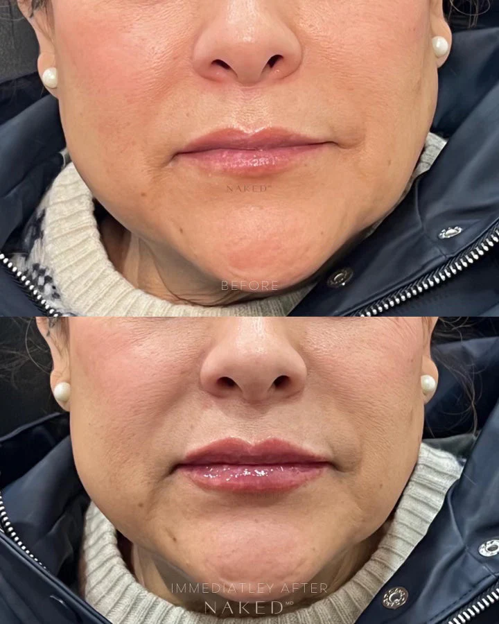 Lip Filler | New Client Offer - Image 58
