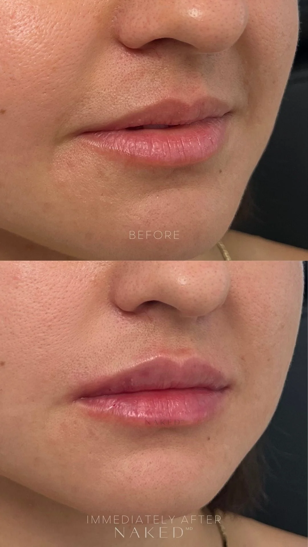 Lip Filler | New Client Offer - Image 6