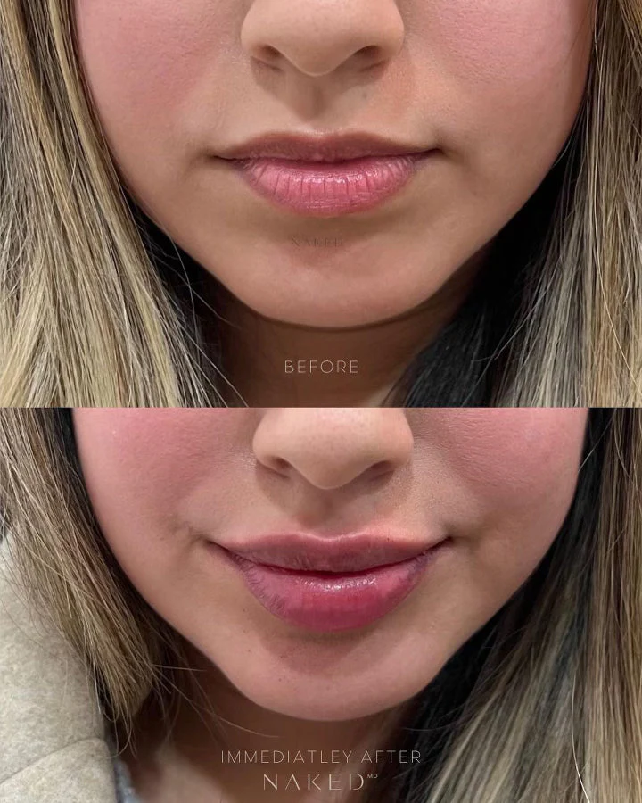 Lip Filler | New Client Offer - Image 60