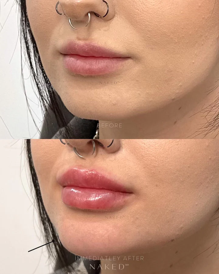 Lip Filler | New Client Offer - Image 63